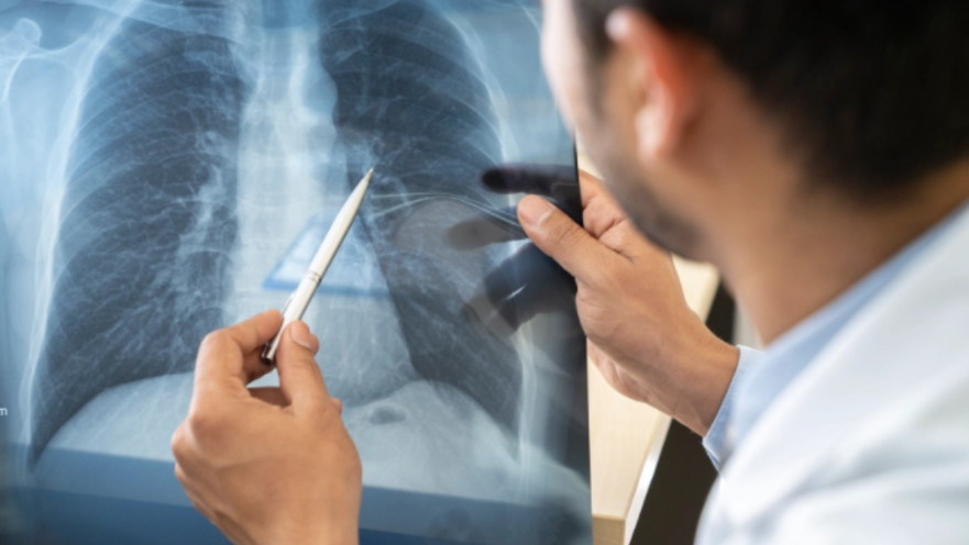 צילום רנטגן ריאות, אילוסטרציה