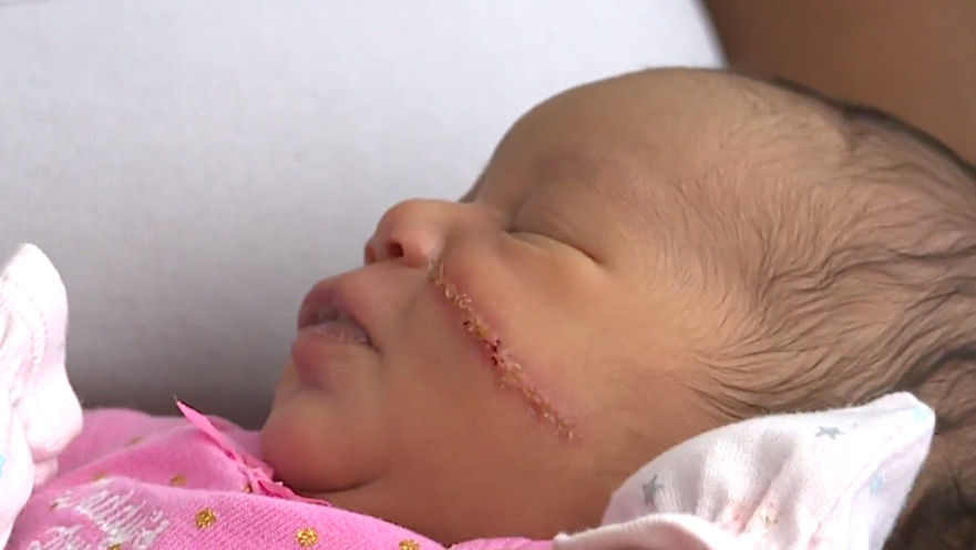 התינוקת שנחתכה בזמן לידתה