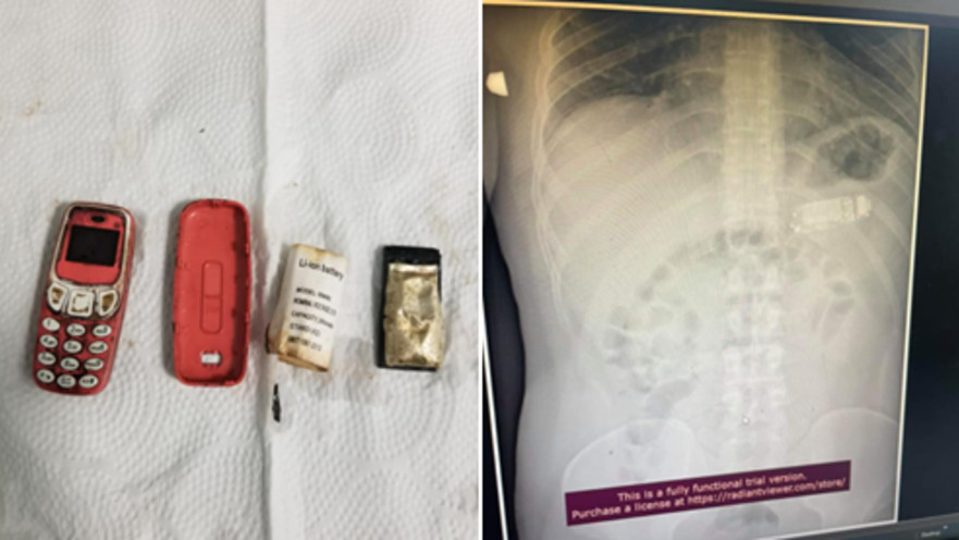 בן 33 בלע טלפון נוקיה