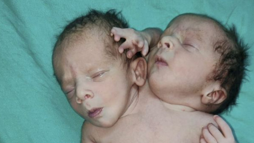 זוג התאומים התגלה כתינוק אחד עם שני ראשים ושלוש זרועות