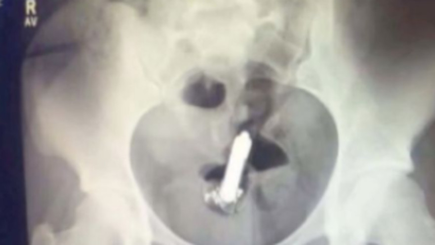 הוויברטור נתקע עמוק מדי, נזקקה לטיפול רפואי כדי לחלץ אותו