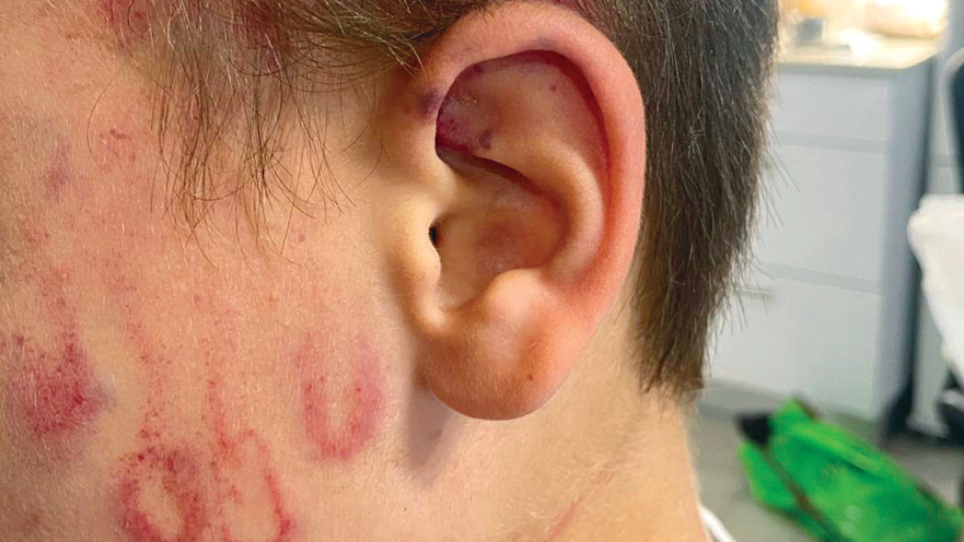 פצעים על גופו של רוי. “איימו להפוך אותו  ל’כוכב טיקטוק’, לאחר שתיעדו את המעשה” 