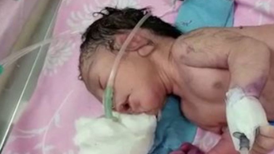  תינוק נולד בהודו עם מבנה דמוי קרן במקום רגליים