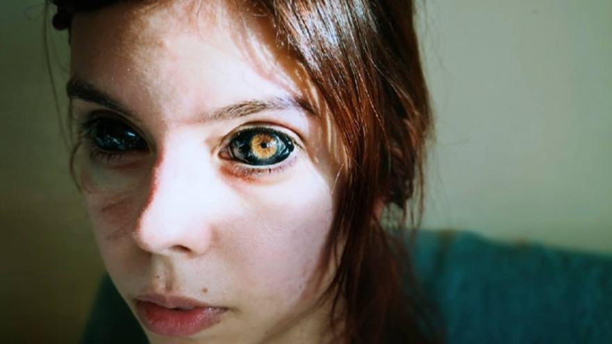 אלכסנדרה סדובסקה, רק רצתה קעקוע והפכה לעיוורת