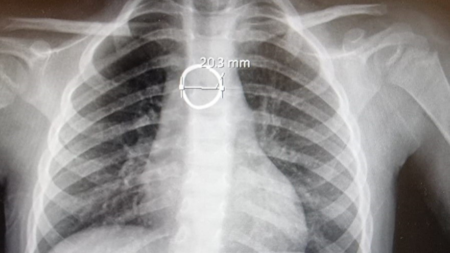 צילום הרנטגן בו נצפתה הטבעת