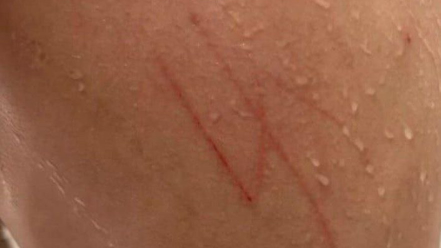 תקפו אותו קשות וחרטו צלב קרס על גבו