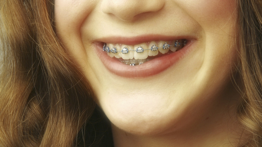 גשר בשיניים, אילוסטרציה