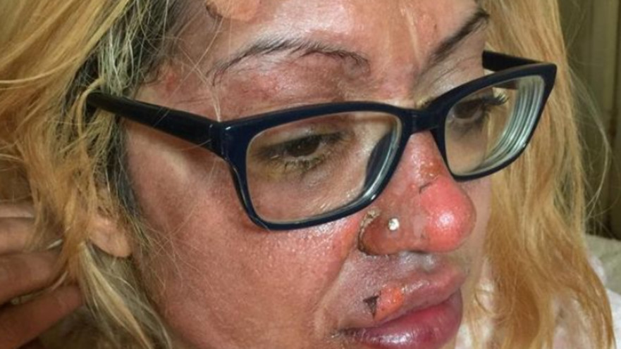 מזעזע: סבלה מכוויות קשות בגלל טיפ שמצאה ברשת