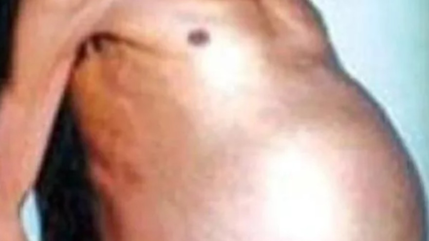 גבר היה "בהריון" 36 שנה