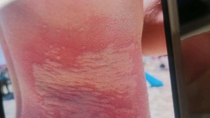 הצריבה בגוף הצעיר