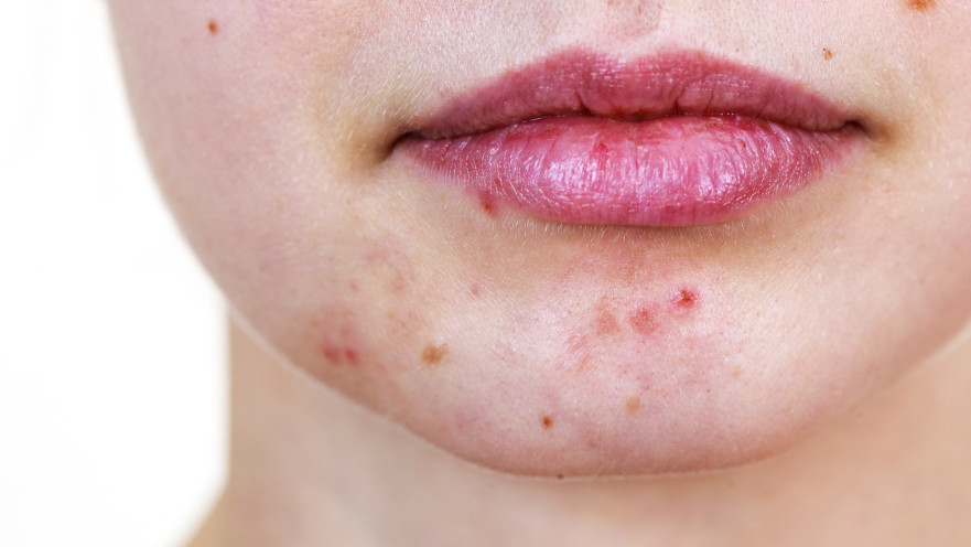 כך נוכל להיפטר מהפצעונים