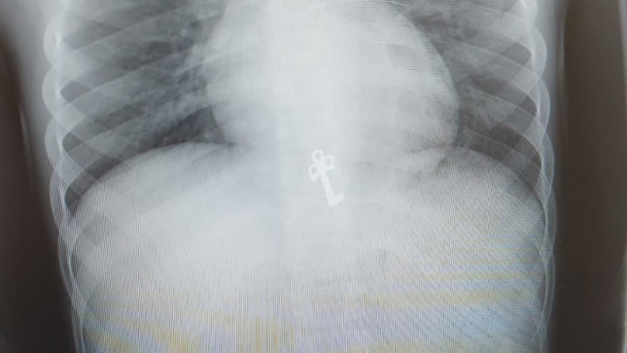 הצילום שנערך לילד, טרם הטיפול הפולשני 