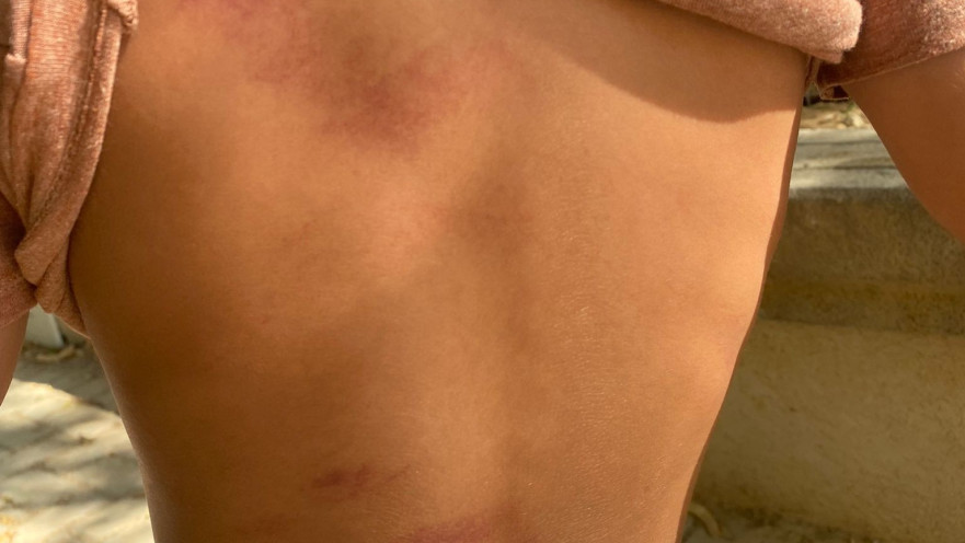 החבלות בגבו של הילד