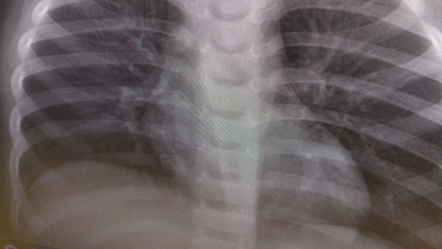 סוללת הכפתור שנבלעה