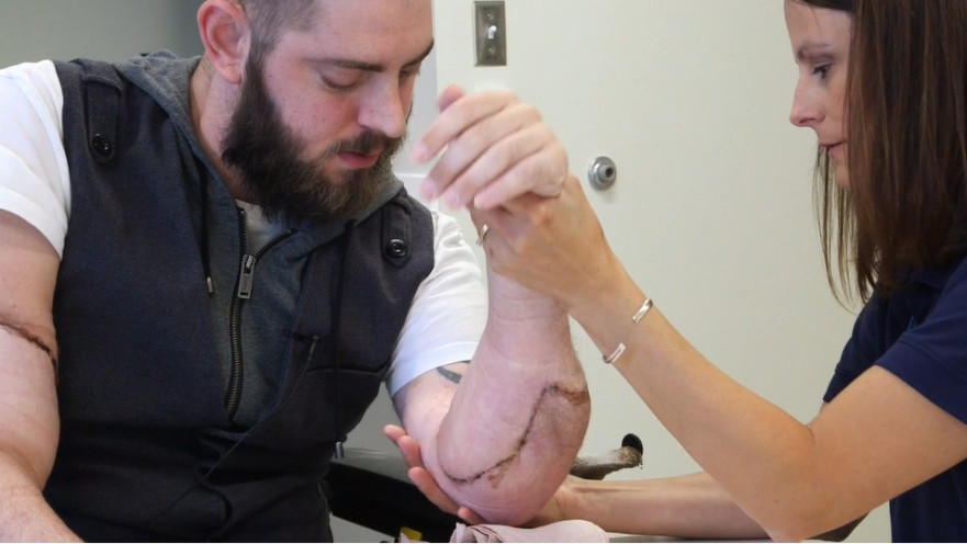 קטועי גפיים