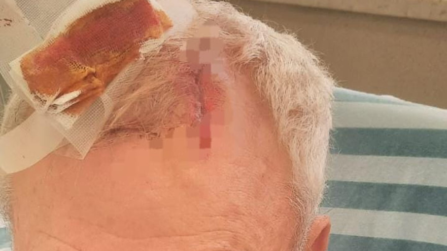 בן ה-73 שהותקף בבקבוק זכוכית על ידי רוכב אופנוע