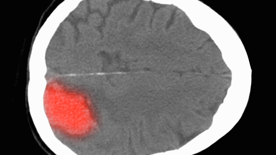 דימום מוחי, אילוסטרציה