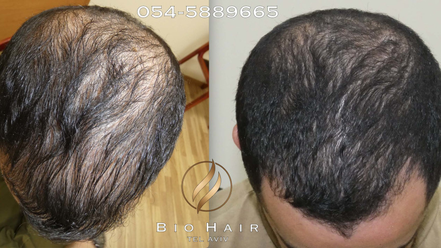 הקרב על השיער