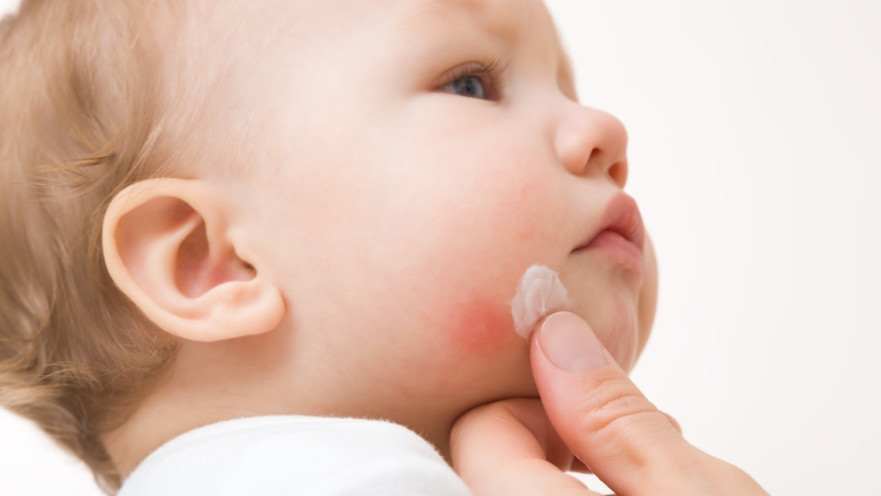 אימפטיגו. הטיפול הראשוני הוא במשחה אנטיביוטית