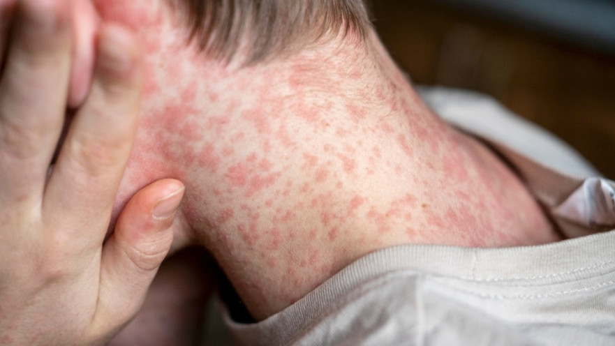 סימפטומים דמויי שפעת ותגובה מוחית. הטיפול כולל תרופות נוגדות אלרגיה