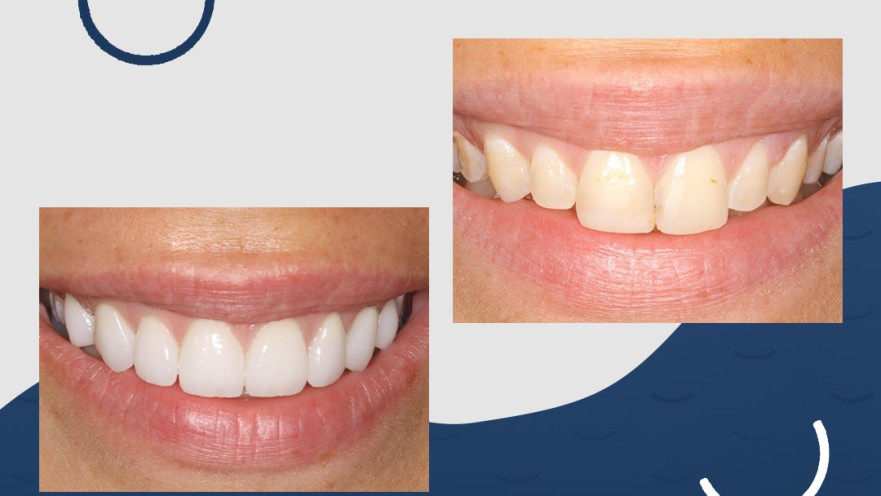 ד"ר רוני אמיד רופא שיניים - ציפוי חרסינה, כתרי חרסינה, כתרי זירקוניה