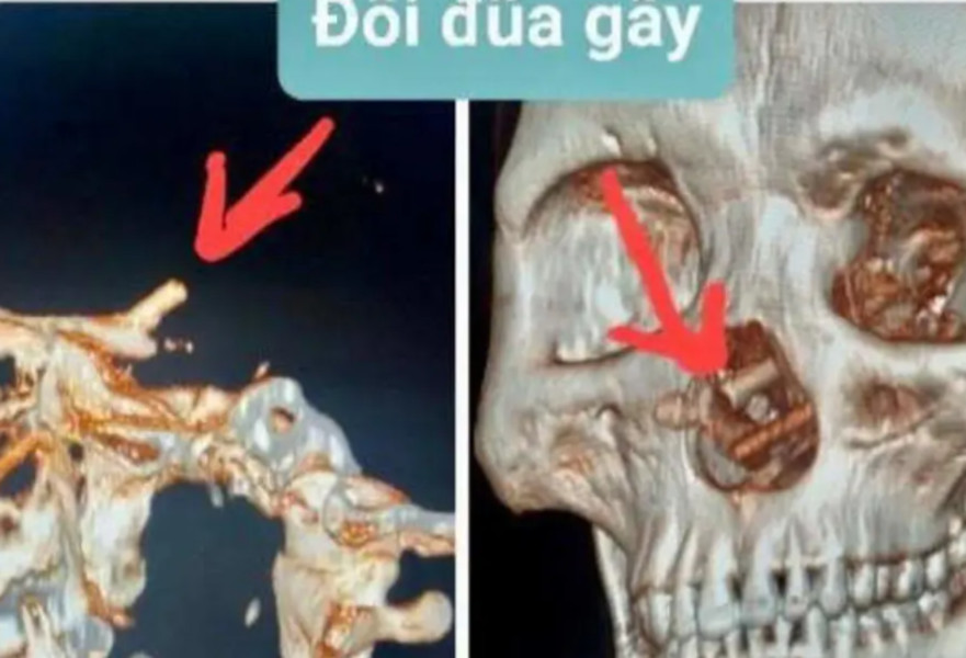 הרגע בו אותרו שני המקלות