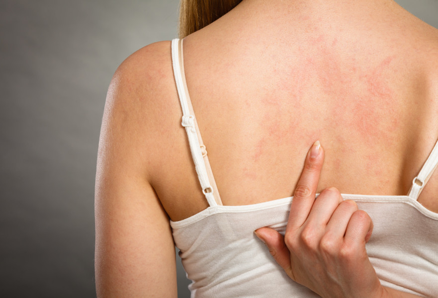 לחץ וסטרס גורמים למחלות עור