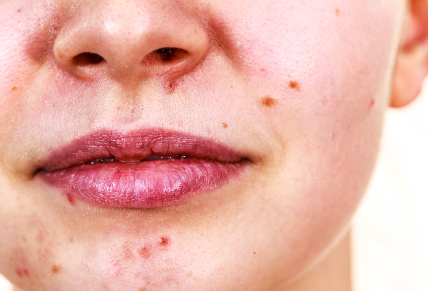 גם אקנה הוא תוצר של לחץ וסטרס