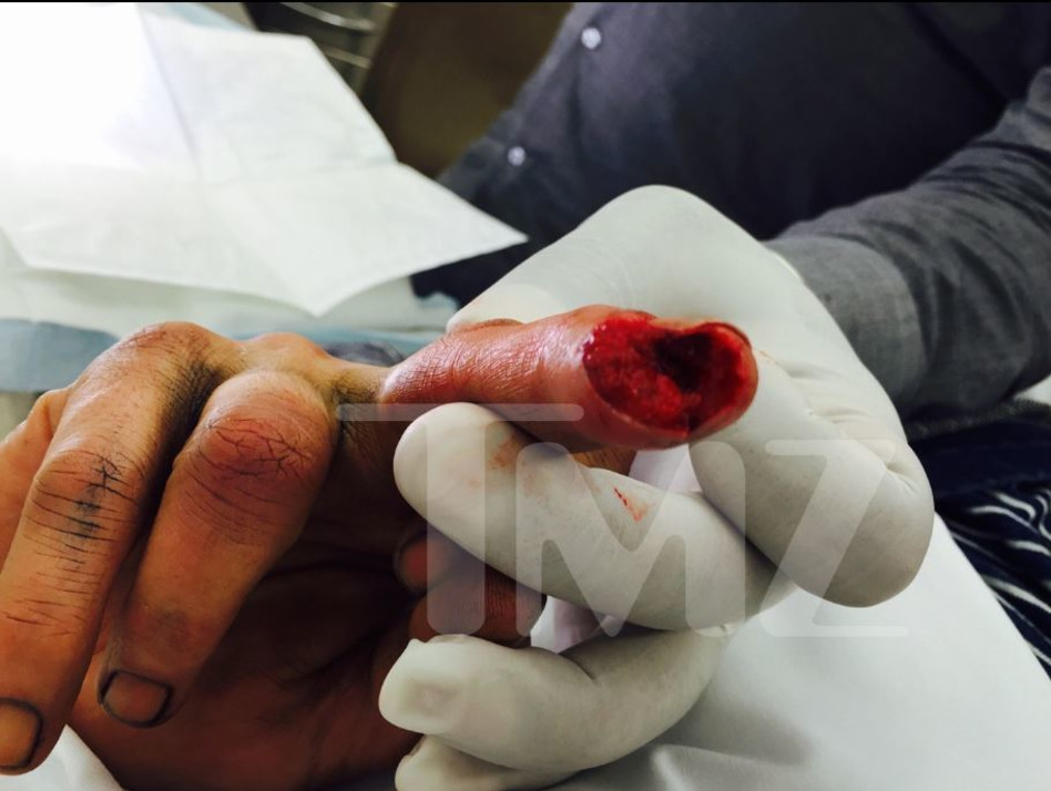 האצבע המדממת של ג'וני דפ (צילום מסך, TMZ)