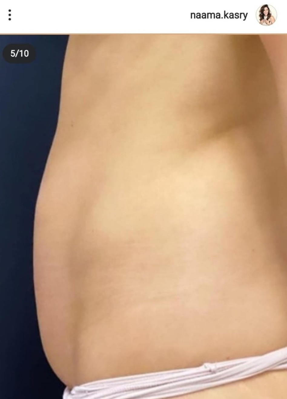 הבטן של נעמה קסרי לפני הניתוח (צילום: צילום מסך אינסטגרם)