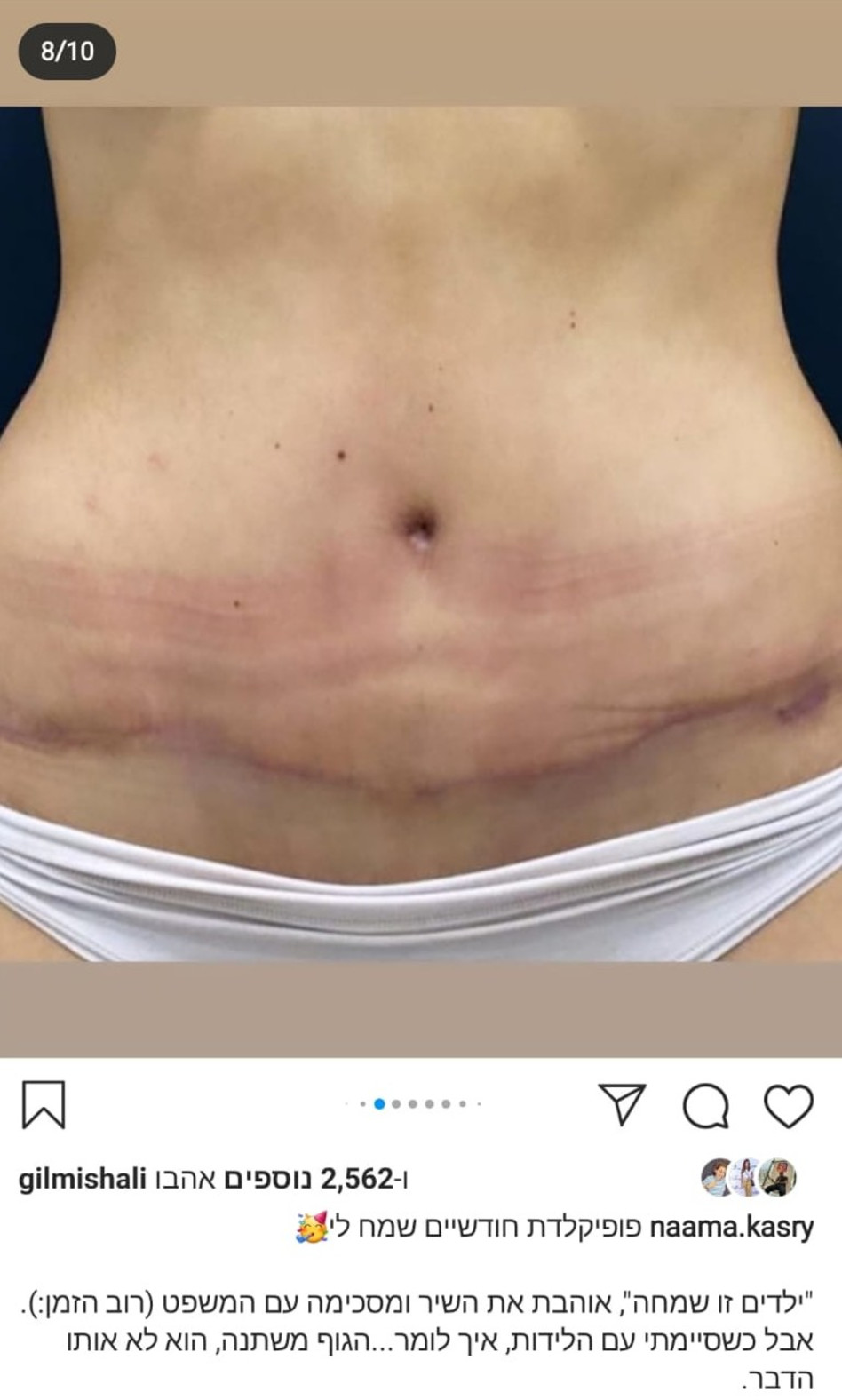 נעמה קסרי אחרי הניתוח (צילום: צילום מסך אינסטגרם)