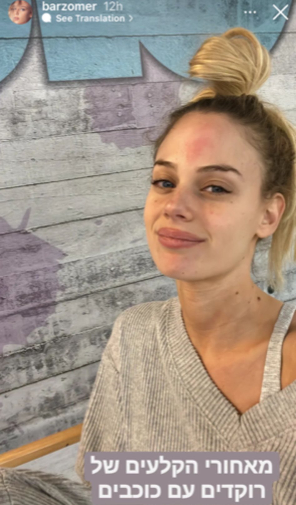 הפציעה של בר זומר (צילום: צילום מסך אינסטגרם)