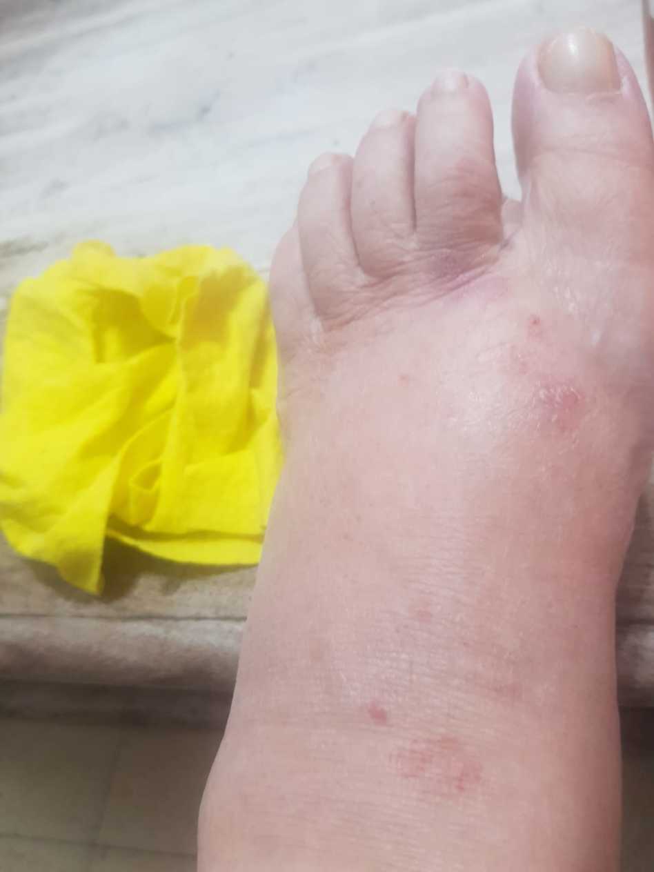 רגלה הנפוחה של יהודית באומן (צילום: פרטי)