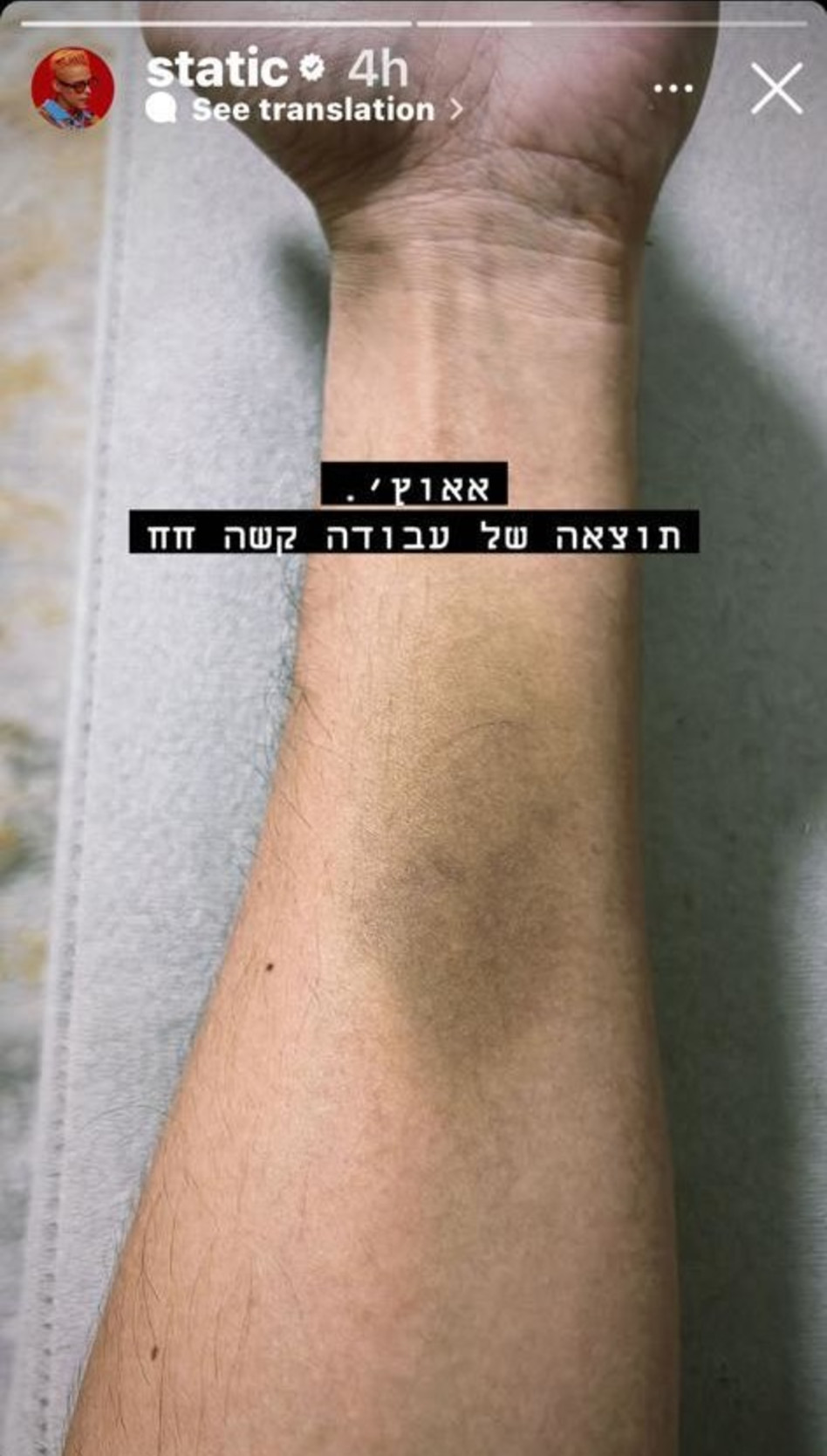 סטטיק נפצע בחזרות (צילום: צילום מסך אינסטגרם)