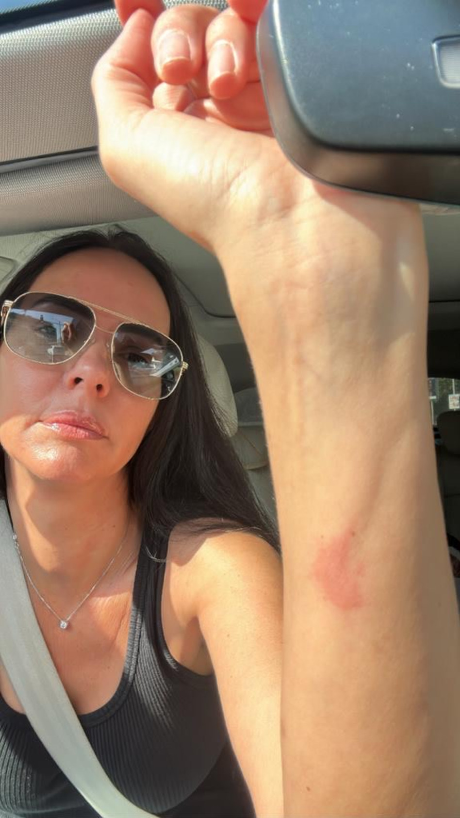 הכוויה שחטפה רוית אסף (צילום: פרטי)