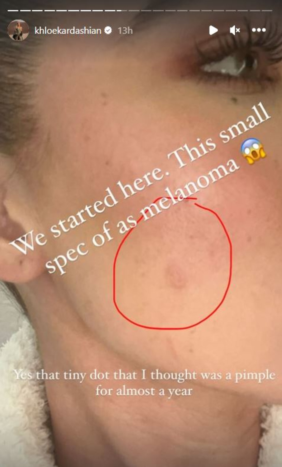 הגידול הסרטני של קלואי קרדשיאן (צילום: צילום מסך אינסטגרם)