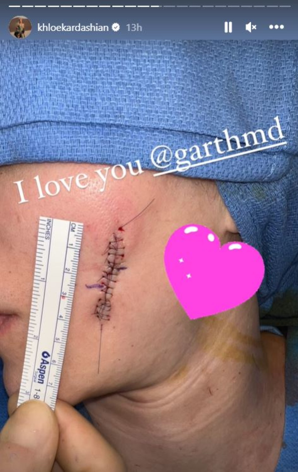 התפרים לאחר הניתוח. קלואי קרדשיאן (צילום: צילום מסך אינסטגרם)