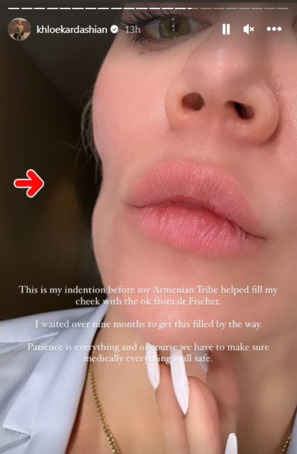 השקע שנוצר לקלואי בעקבות הניתוח שעברה (צילום: צילום מסך אינסטגרם)