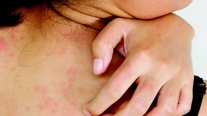 אישה מגרדת בגלל פריחה 