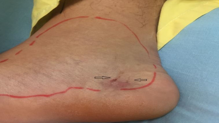 סימני ההכשה. צילום: בי&quot;ח קפלן