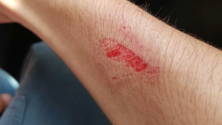 סימני נשיכה על שוטר מהקטטה מול &quot;סופר יודה&quot;, צילום: דוברות משטרת ישראל