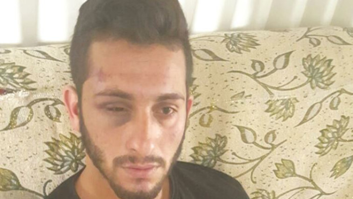 מייסם אבו-אלקיעאן  לאחר שהוכה