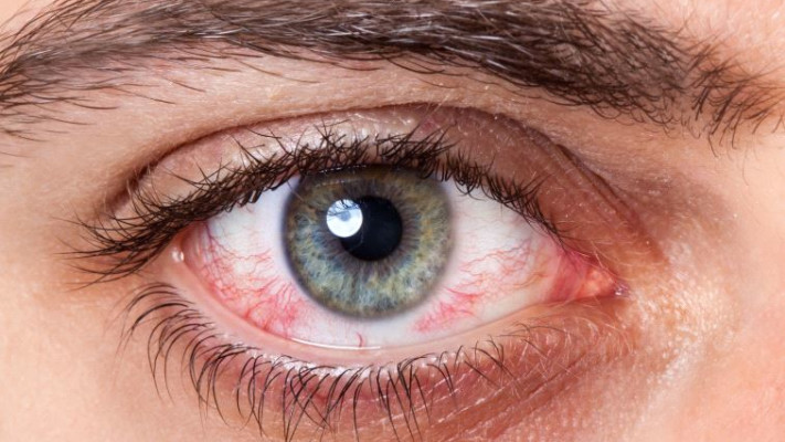 דלקת חריפה של חלקי העין. נגרמת מחיידקים או פטריות