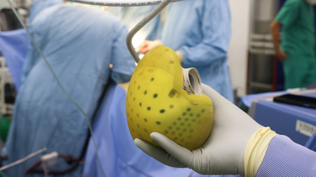 השתלת לב אנושי (צילום: יחידת הצילום, שיבא)