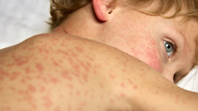 חצבת (צילום: שאטרסטוק)