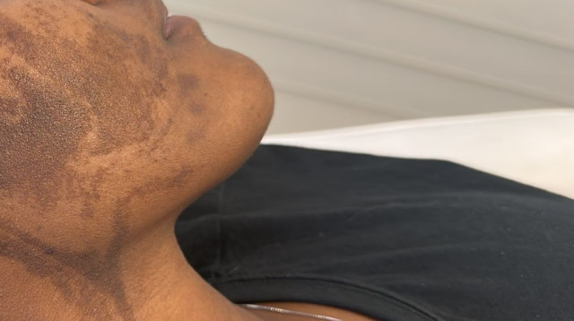 כוויות פנים משריפה אחרי (אלינור אור קוסמטיקס) (צילום: יחצ)