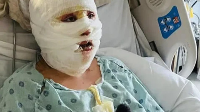 צעירה בת 19 כמעט נשרפה למוות (צילום: HotSpot Media)