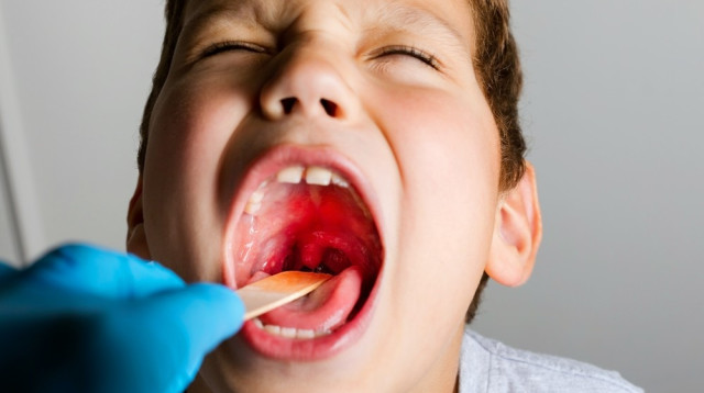 משטח גרון. עליה משמעותית במקרי ההתפשטות (צילום: שאטרסטוק)