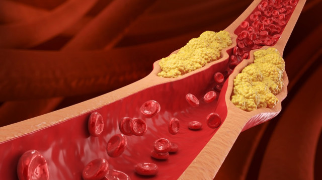 ליפופרוטאין. גורם סיכון משמעותי להתקפי לב (צילום: שאטרסטוק)