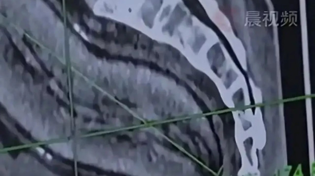 תפוח אדמה בבטנו של הגבר (צילום: רשתות חברתיות)